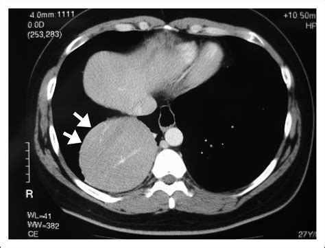 Right Sided Bochdaleks Hernia In An Adult The American Journal Of