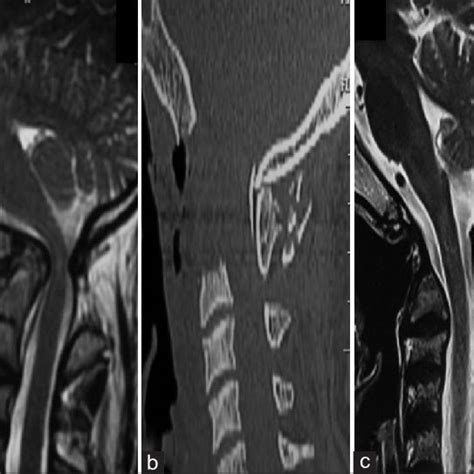 A Magnetic Resonance Imaging T2 Weighted Sagittal Images Showing