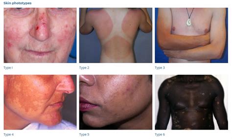 Photoaging Causes Prevention Signs Diagnosis And Treatment