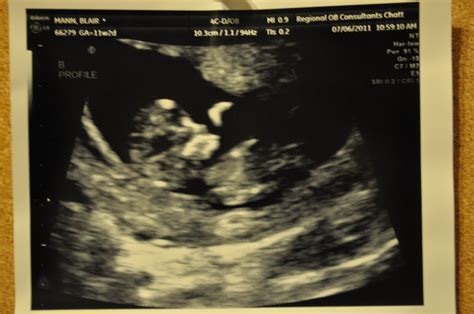 Little Mann Girls Ultrasound 11 Weeks