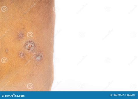 Dermatite Dermatite Alérgica Doente Do Prurido Ou Pele Da Eczema Nos Pés Imagem de Stock