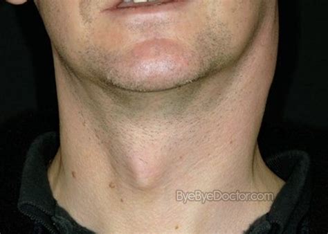 Lymph Nodes Causes Of Swollen Lymph Nodes In Neck