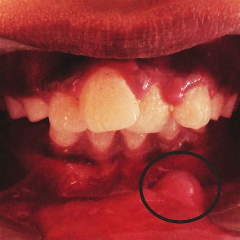 Pdf Oral Mucocele Review Of Literature And Case Report