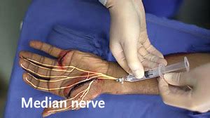 Peripheral Nerve Blocks For Hand Procedures NEJM