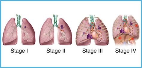 Lung Cancer Staging St Stamford Modern Cancer Hospital Guangzhou