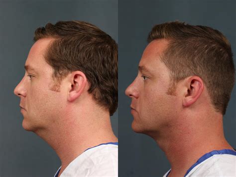 Neck Lift Before And After Photos Patient 726 Louisville And Lexington