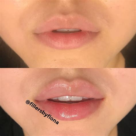 Lip Shapes With Lip Fillers Lip