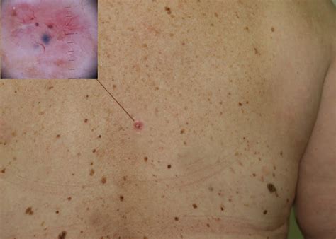 Skin Cancer Skin Cancer Early Stages