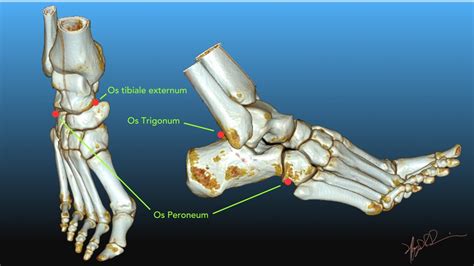 Common Accessory Ossicles Of The Foot Uw Emergency Radiology