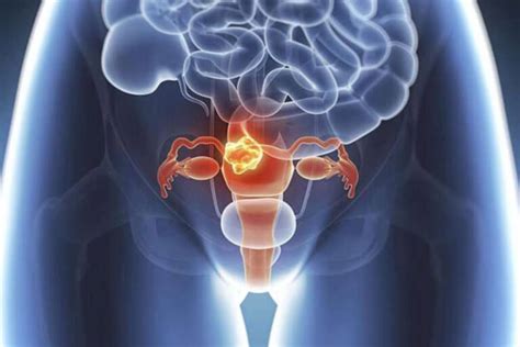 Endometrial Cancer Symptoms Risks And Treatments