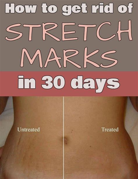 Stretch Marks How To Get Rid Health And Beauty