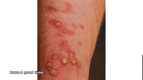 Fungal Skin Infections Youtube