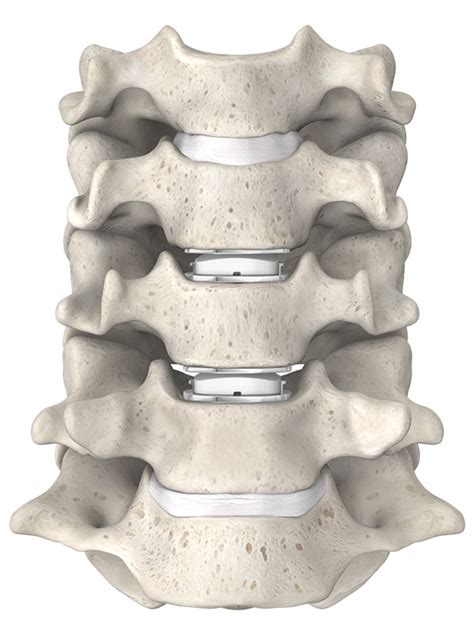 Mobi C® Artificial Cervical Disc Replacement Spinecare Medical Group
