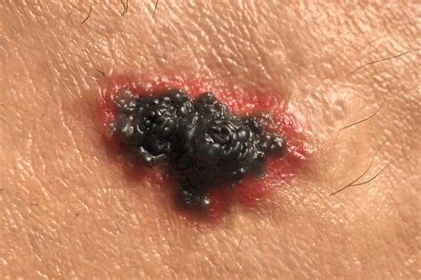 Skin Cancer Symptoms How To Check For Moles Readers Digest