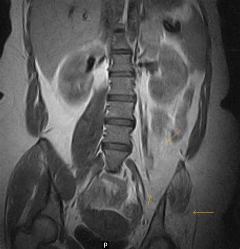 Post Polio Iliopsoas Atrophy Mri Sumers Radiology Blog