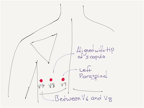 Lead Placement For Posterior Ecg Resus Review