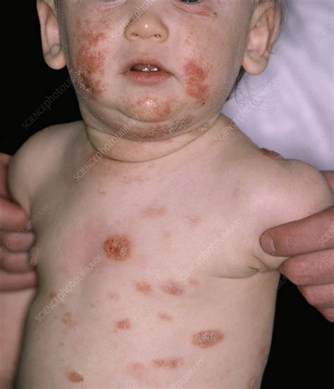 Infected Atopic Dermatitis Stock Image C0514584 Science Photo
