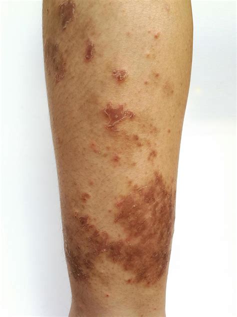 Young Boy Has Chronic Rash On Skin Grass Allergic Skin Disease Atopic