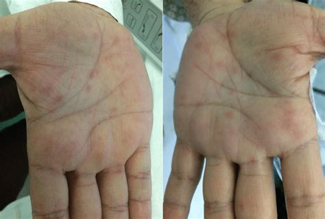 Erythematous Maculopapular Rashes On The Palms Of Both Hands Download