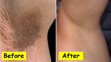 How To Lighten Dark Underarms Works How To Get Rid Of Dark Armpits Youtube