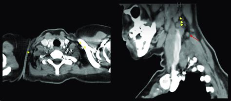 Contrast Enhanced Ct Neck And Thorax Multiple Bilateral Enlarged Deep