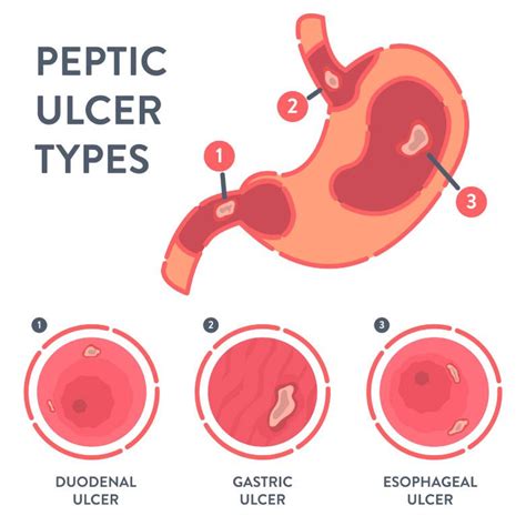 Demystifying Peptic Ulcers Causes Symptoms And Treatment