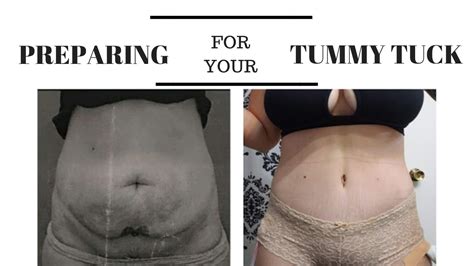 How To Care For Belly Button After Tummy Tuck Amado Capelli