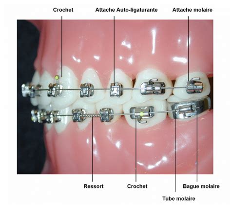 Système Multi Attaches Autoligaturant Orthodontiste Dr Robert