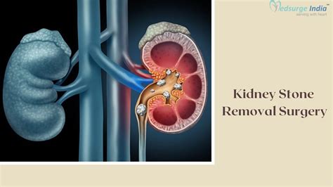 Kidney Stones Removal Surgery Cost In India Medsurge India