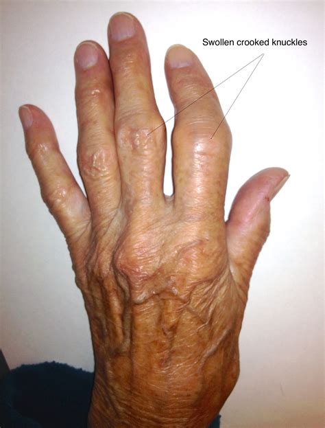 Hands Arthritis Oxford Orthopaedics