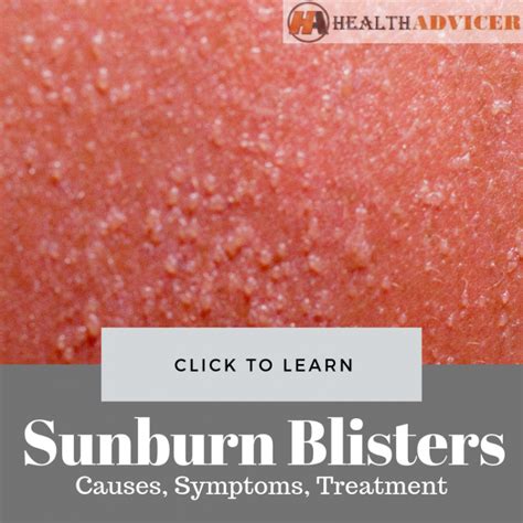 Sunburn Blisters Causes Picture Symptoms And Treatment