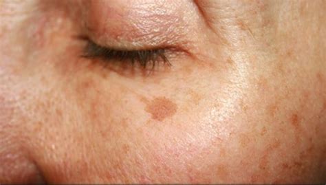 Age Spots On Face Causes And Ways To Fade Them Skincarederm