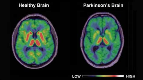 Drug Ice Can Cause Changes In Brain Similar To Parkinsons Disease