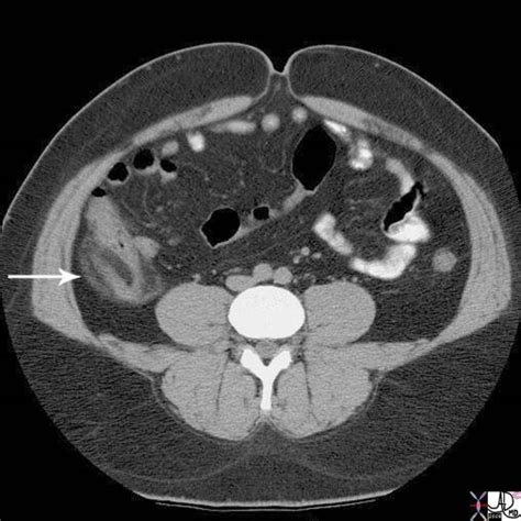 Acute Appendicitis Images Bmc Radiology