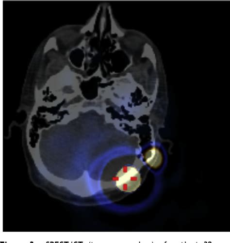Figure 3 From The Role Of Hybrid Spectct For Lymphatic Mapping In
