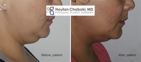 Double Chin Treatment Without Liposuction Potomac Plastic Surgery