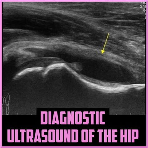 Iliopsoas Bursitis Ultrasound