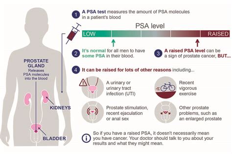 Prostate Cancer Exam