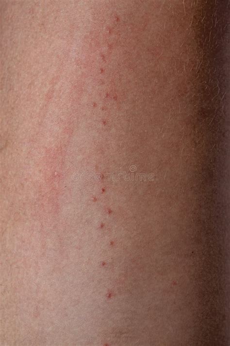 Allergic Reactions To Tick Bites Stock Photo Image Of Allergic