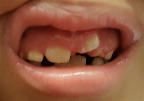 What Should I Do About A Childs Permanent Tooth Thats Growing In The