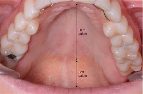 How To Tell If The Tongue Is On The Soft Palate Magnum Workshop