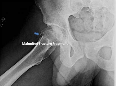 Open Hip Dislocation St Louis Mo Pao Surgery Missouri