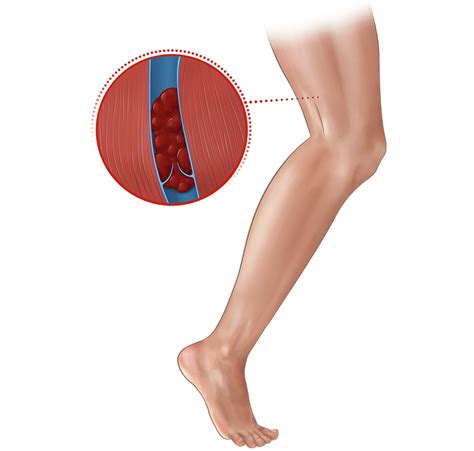 Deep Vein Thrombosis Deep Vein Thrombosis Symptoms Hot Sex Picture