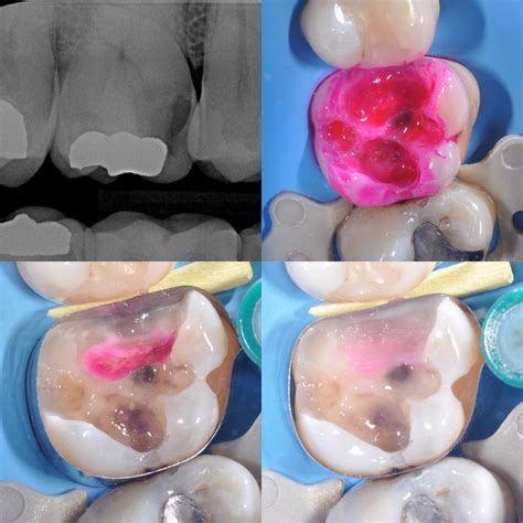 Lesson 1 Diagnosis And Treatment Of Caries The Hybrid Layer