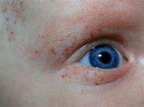 Gallery For Petechiae Face Child