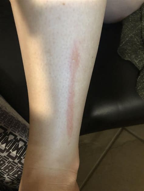 Whats This Raised Itchy Line On My Leg Diagnoseme