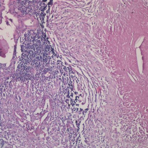 Warthin Tumor Prominent Epithelial Component With Tall Oncocytic