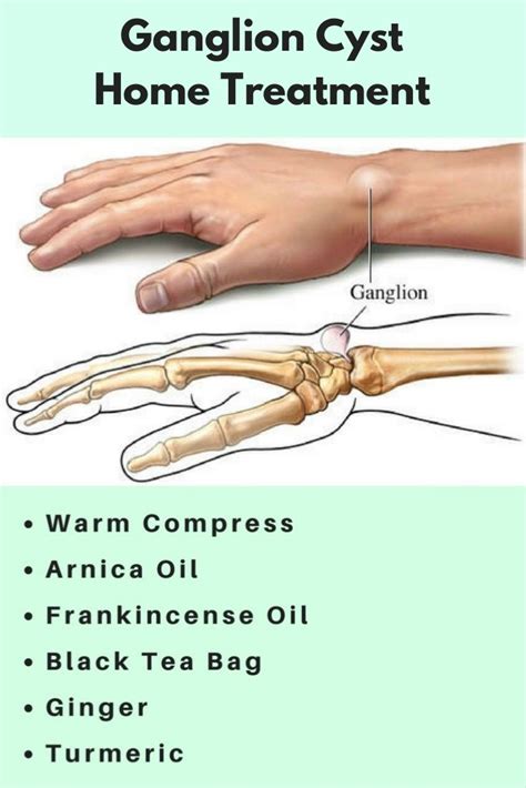 How Do You Get Ganglion Cyst On Your Foot Margaret Gr Vrogue Co