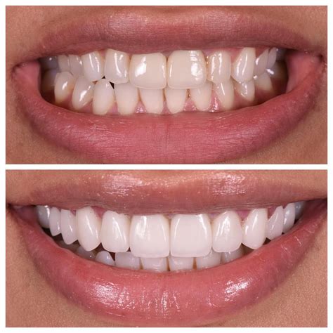 Before And After Laminate Veneers Before And After
