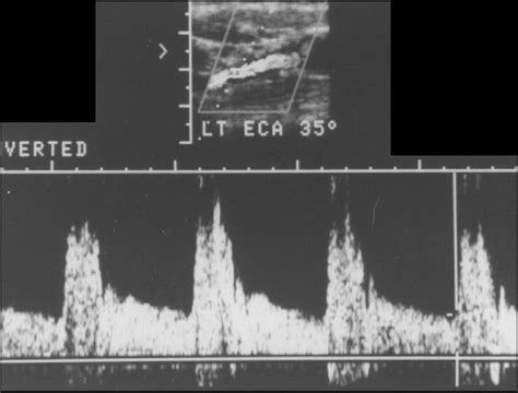Figure 15 From A Spectrum Of Doppler Waveforms In The Carotid And